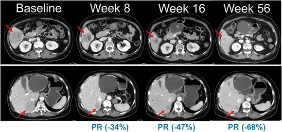 ▲NRAS 돌연변이 흑색종 환자를 대상으로 진행된 벨바라페닙과 코비메티닙 병용요법 임상시험에서 시간 경과에 따른 병변 변화가 관찰된 복부 CT 영상. / 사진=미국임상종양학회(ASCO) 2021 구연 발표 한미약품 흑색종 신약 ‘벨바라페닙’, 임상 2상 환자 투약 시작